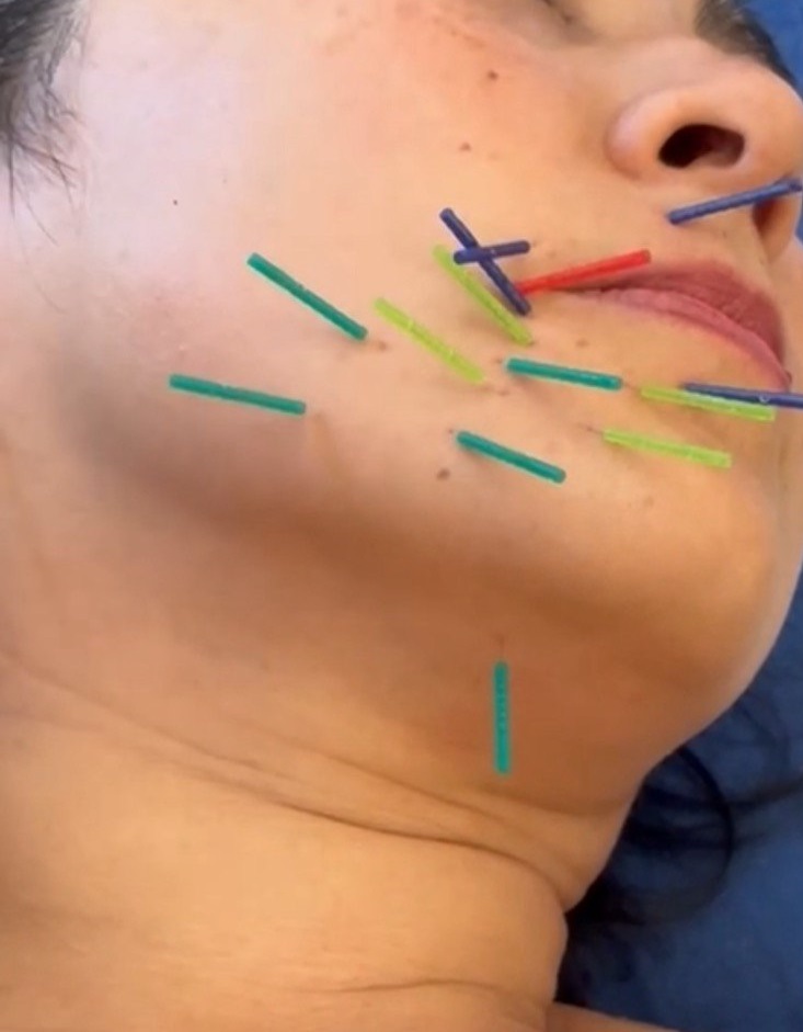 Cosmetic Acupuncture